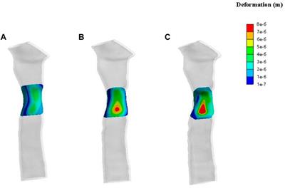 A preliminary biomechanical study on trachea reconstruction surgery using the clavicular periosteum